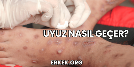 Uyuz Nasıl Geçer?